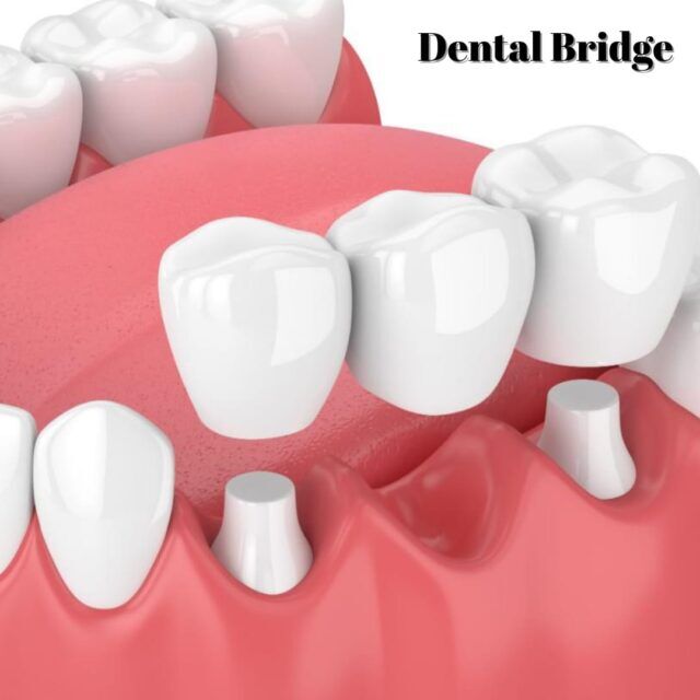 dental-bridge-in-turkey-cost dental bridge turkey cost