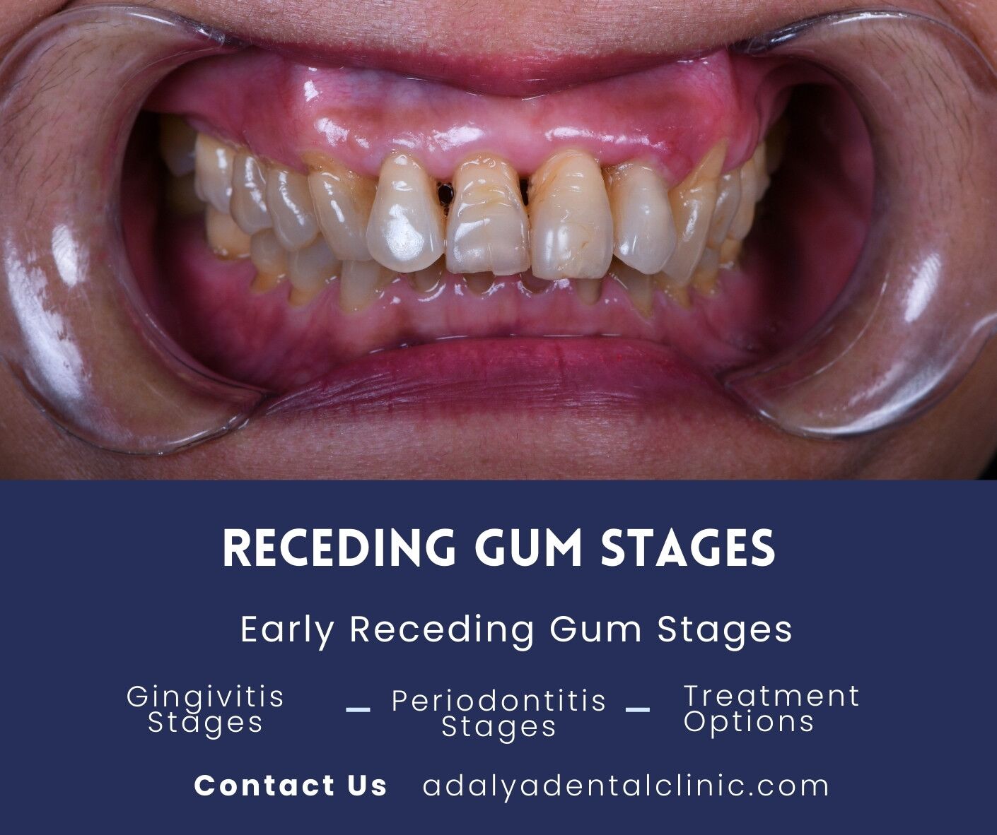 receding gum stages