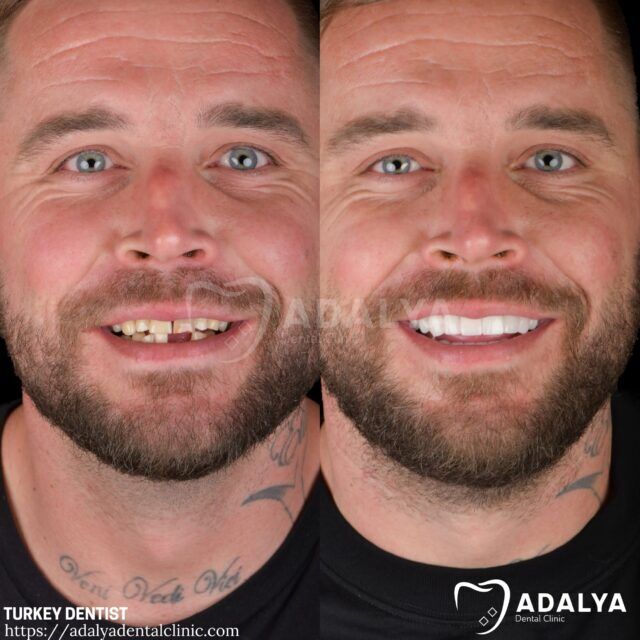 turkish-dental-crowns-turkey-cost-antalya-full-mouth turkish dental crowns turkey cost antalya full mouth