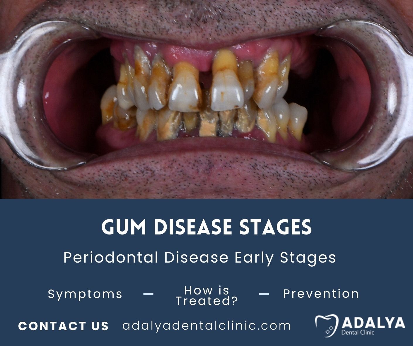 gum disease stages