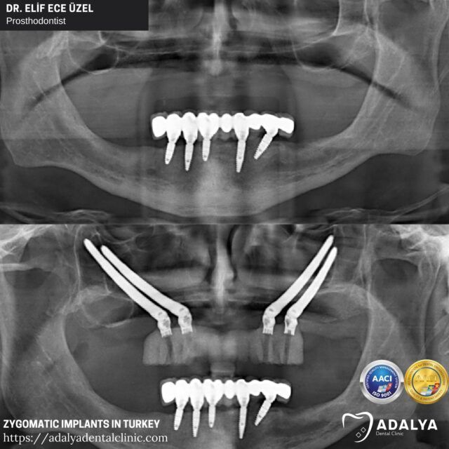 zygomatic-implants-cost-turkey-antalya-price zygomatic implants cost turkey antalya price