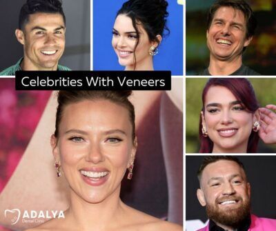 35 Celebrities With Veneers: Before and After Transformations