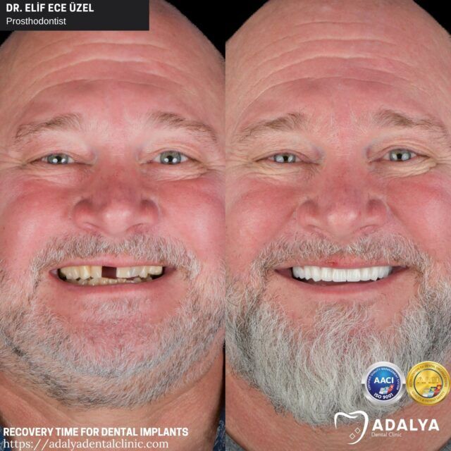 When Can I Go Back To Work After Dental Implant Surgery in Brooklyn Florida thumbnail