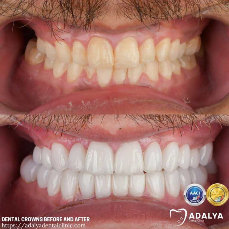 dental-crowns-before-and-after-adalya-dental-clinic