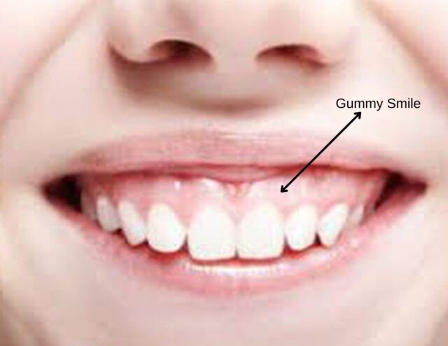 gummysmilecorrection gum contouring turkey cost gummy smile correction fix treatment