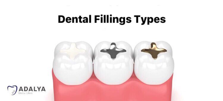Dental fillings types