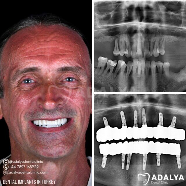 all-on-6-dental-implants-turkey-price-antalya all on 6 dental implants turkey price antalya