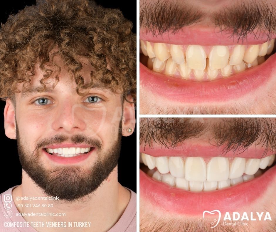 Turkey Teeth Veneers Before and After | Adalya Dental Clinic