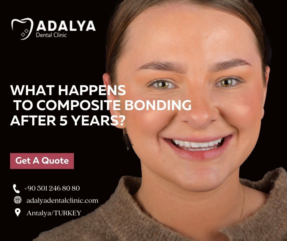 composite bonding after 5 years