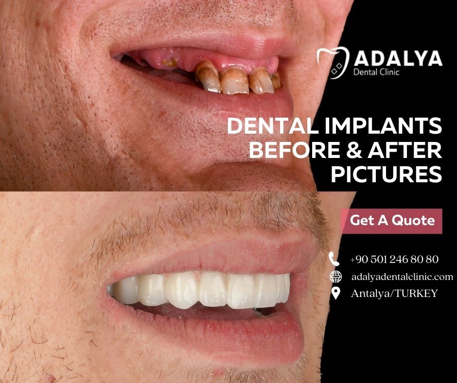 Same Day Dental Implants