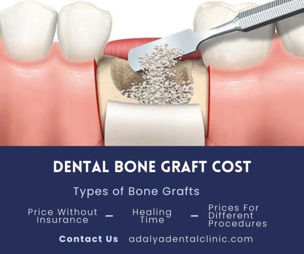 Dental Bone Graft Cost For Teeth, Implant, Cost Without Insurance
