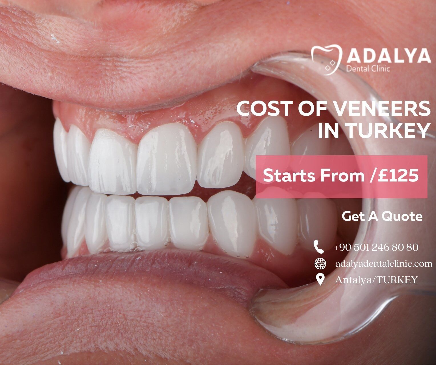 cost of veneers in turkey
