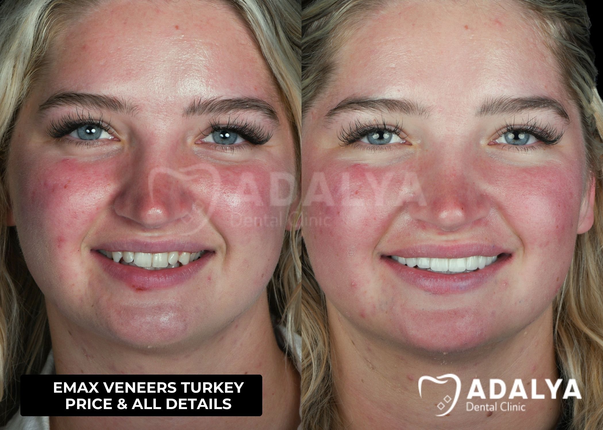emax veneers cost turkey
