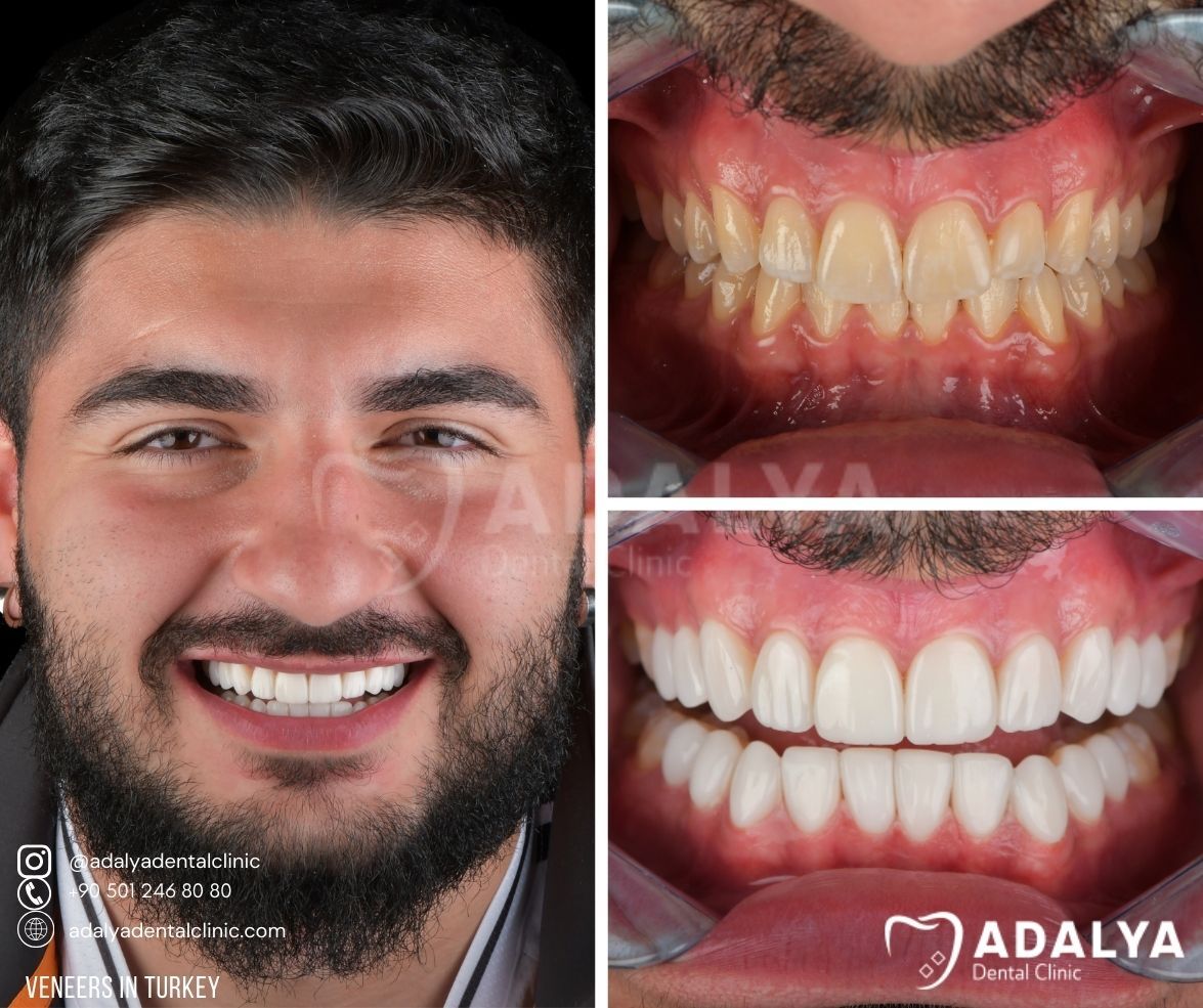 Cost of Veneers in Turkey 2025 Porcelain Teeth Prices, Reviews