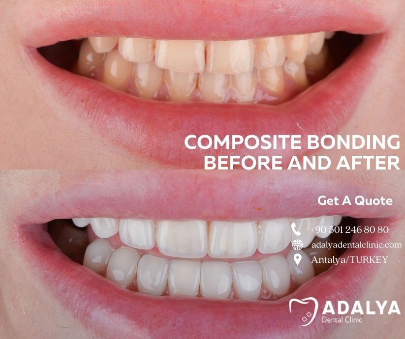 composite bonding before and after