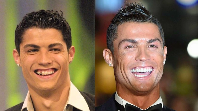 cristiano-ronaldo-celebrity-veneers-before-after