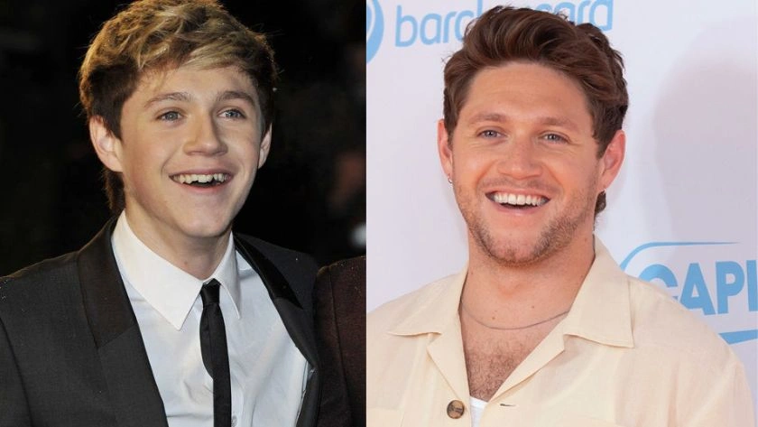 niall-horan-before-veneers-and-after