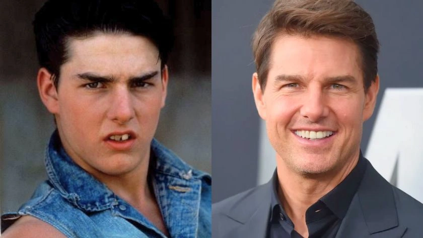 Tom-Cruise-Veneers-Before-And-After