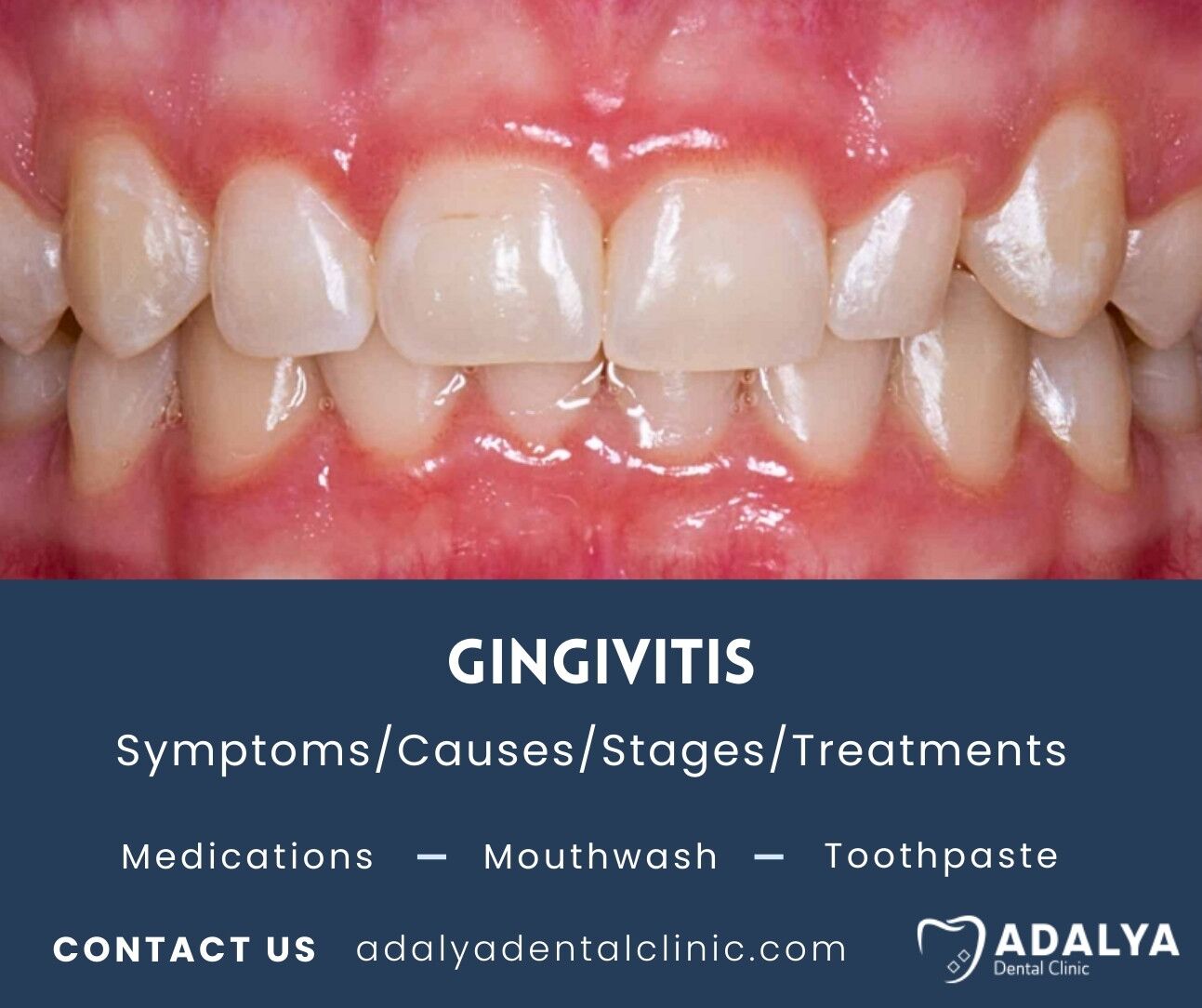 gingivitis symptoms treatment
