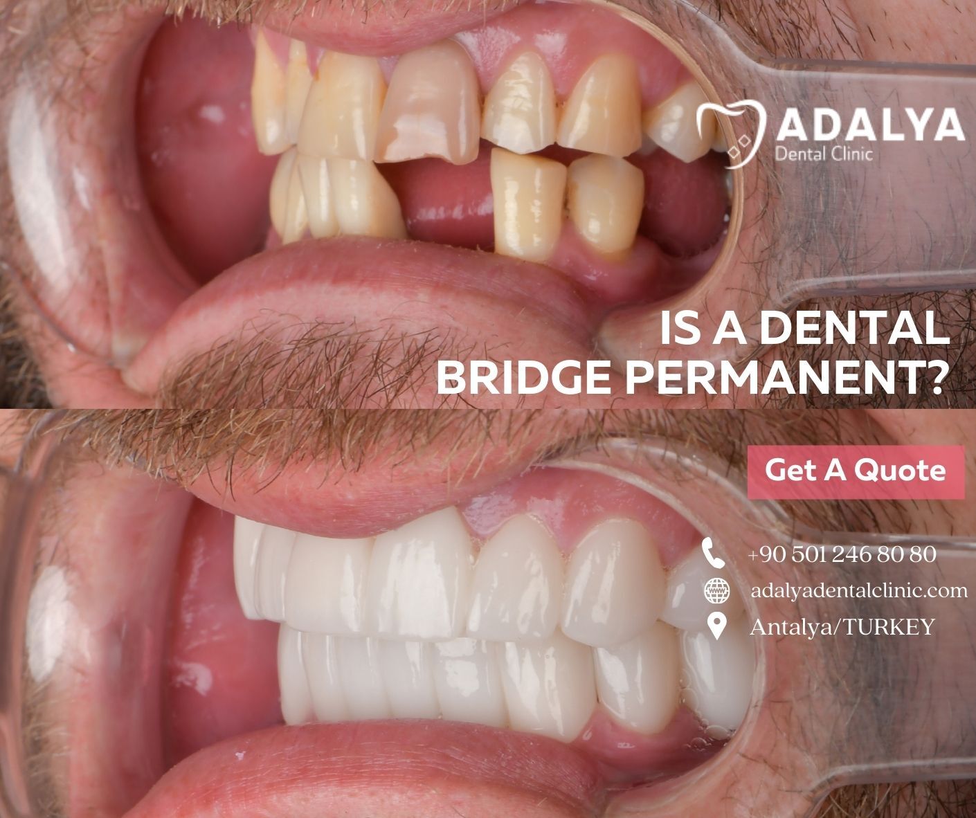 is a dental bridge permanent
