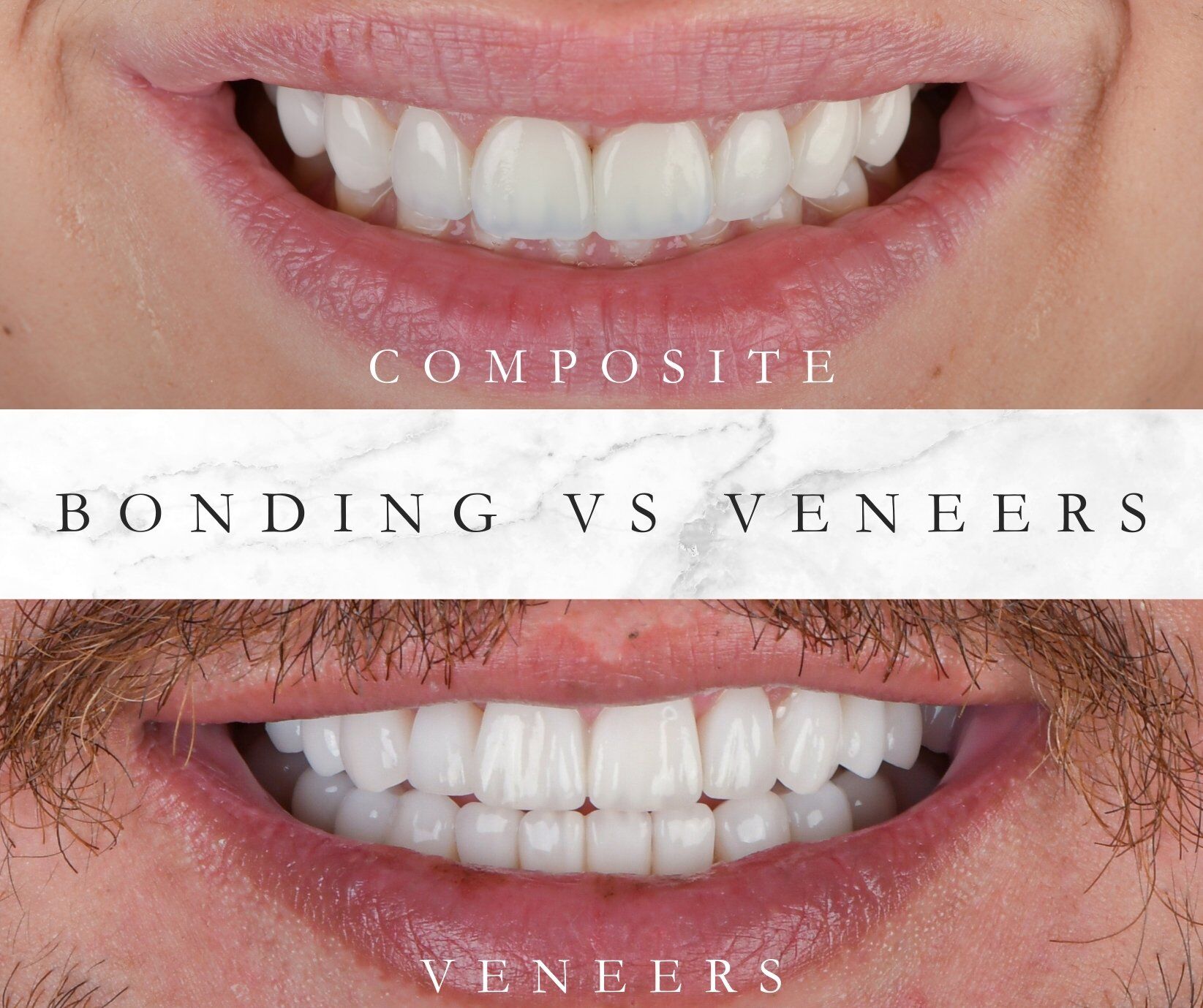 composite teeth bonding vs veneers