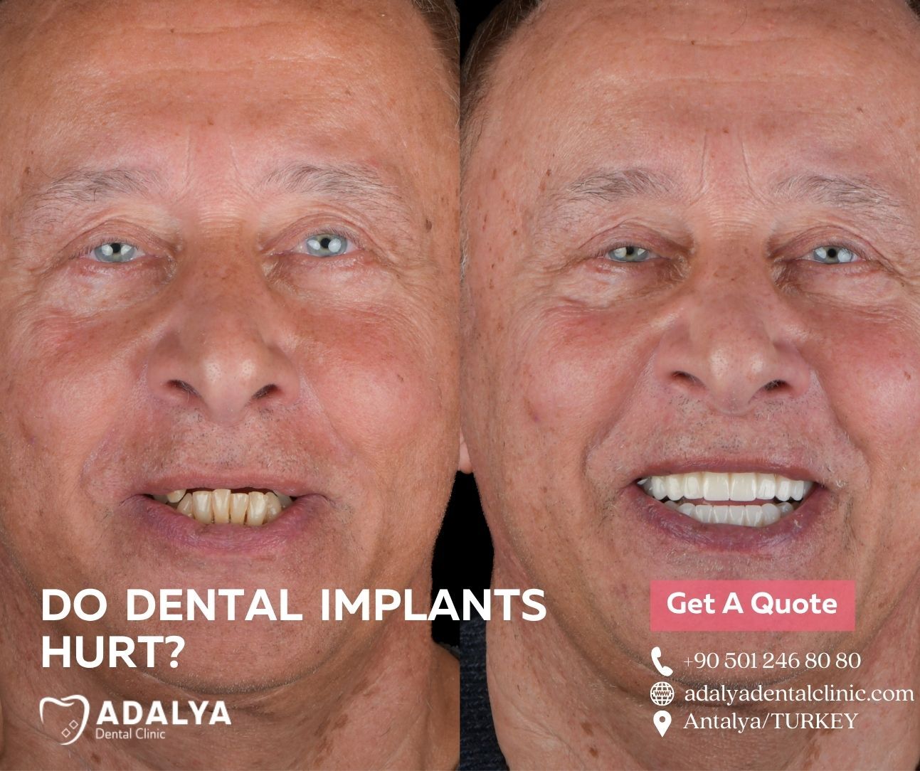are dental implants painful