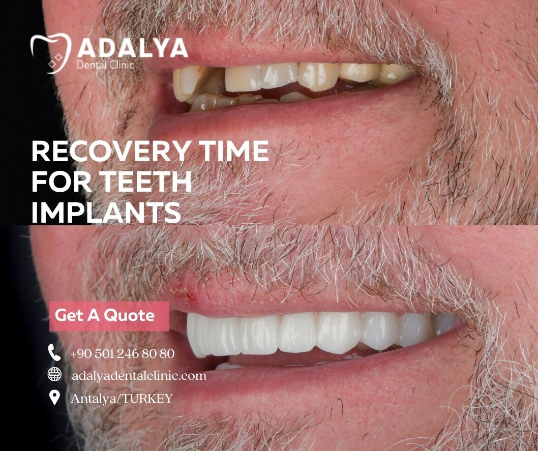 recovery time for teeth implants