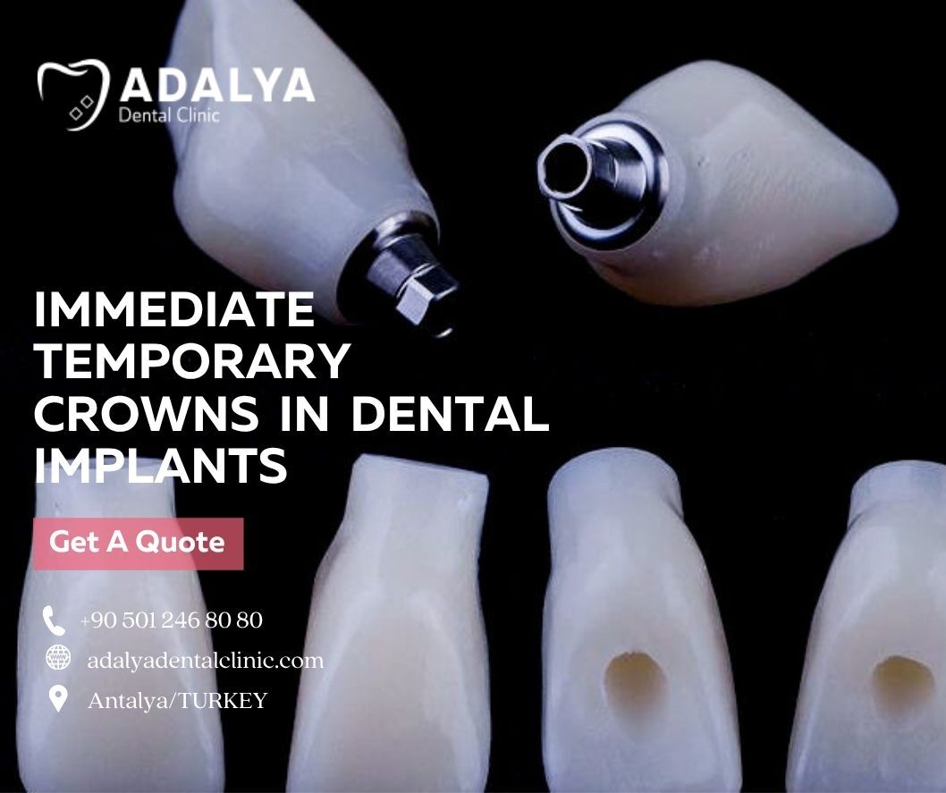 immediate temporary crowns loading in dental implants