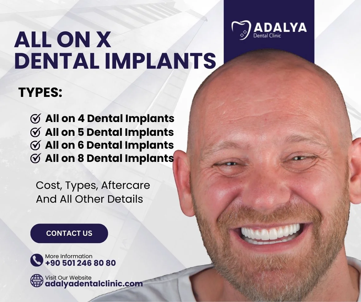 all on x dental implants