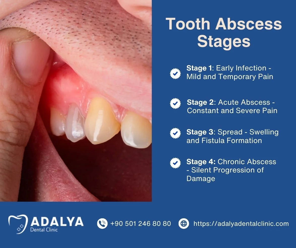 tooth abscess stages
